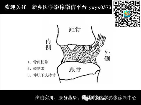 全面了解跗骨窦综合征