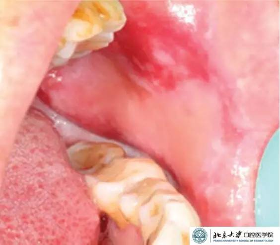 口腔扁平苔藓 口腔扁平苔藓(olp)(图1)是一种最常见的慢性炎症性口腔