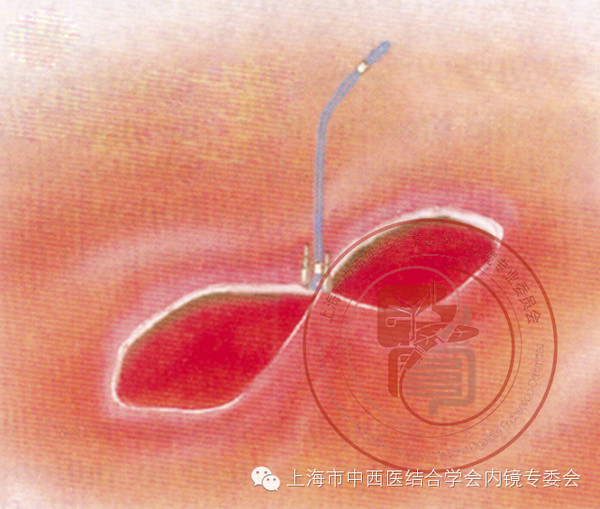 消化内镜专业护理系列-内镜下尼龙套扎操作