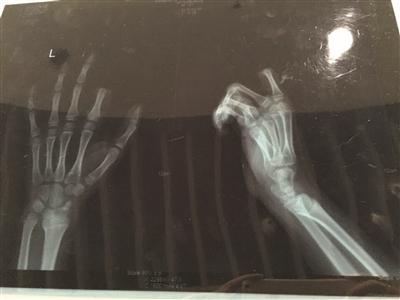 11岁男孩切下左手食指 因父亲责备玩手机(图)
