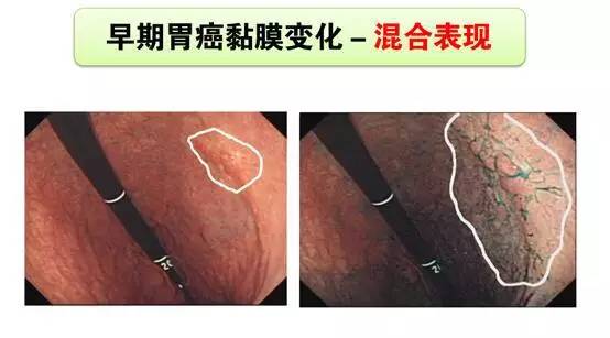 手把手教你利用胃镜发现早期胃癌