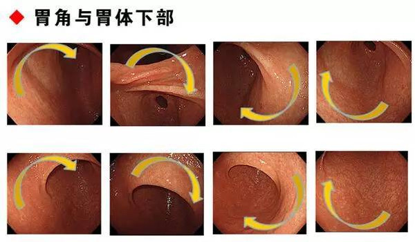 手把手教你利用胃镜发现早期胃癌