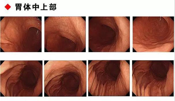 手把手教你利用胃镜发现早期胃癌