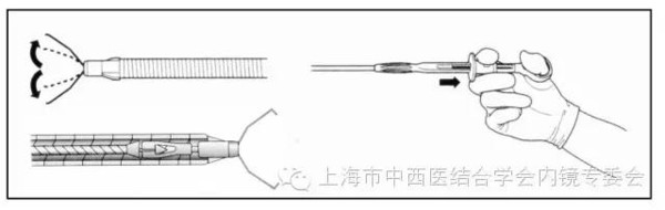 消化内镜专业护理系列-内镜下金属夹子操作