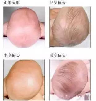 头型是可以慢慢改善的,那如果妈妈太粗心了,不小心把宝宝的头睡偏了