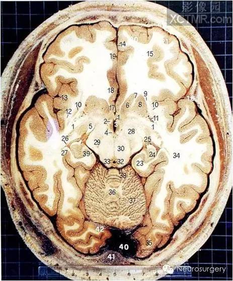 颅脑断层解剖图,这些才是经典!