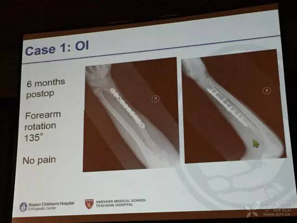 aaos02年会亮点计算机辅助023d02打印助力前臂骨折畸形愈合