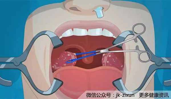 "防御大使"扁桃体发炎的那些年喉咙这是怎么了?