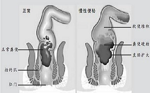 便秘艾灸哪里？便秘艾灸什么穴位好？ .艾灸养生