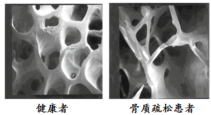 骨质疏松症(osteoporosis op)是一种以骨量低下,骨微结构破坏,导致骨