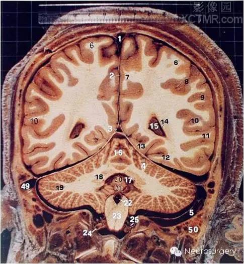 窦 2,大脑镰 3,直窦4,小脑幕 5,乙状窦 6,顶上小叶7,楔前叶 8,顶内沟