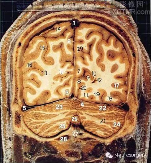 1,上矢状窦2,大脑镰 3,直窦 4,小脑幕5,横窦 6,距状沟 7,距状沟上唇8