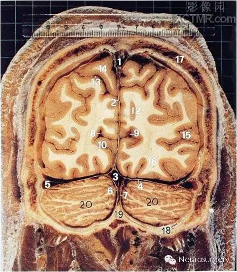 上矢状窦 2,大脑镰 3,直窦4,小脑幕 5,横窦 6,小脑镰7,枕窦 8,距状沟