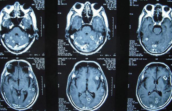 脑转移瘤的诊断治疗
