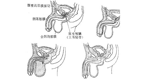 关于尿道损伤及治疗常见问题