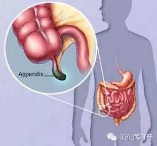右下腹隐痛2天了,盲肠炎不开刀会不会有危险