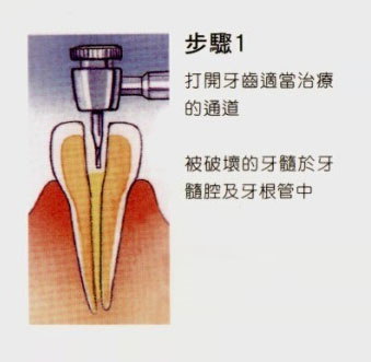 牙齿做根管治疗的步骤和费用