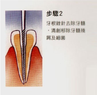 牙齿做根管治疗的步骤和费用