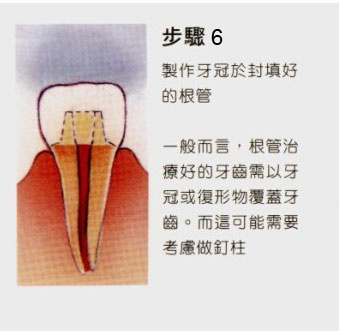 牙齿做根管治疗的步骤和费用