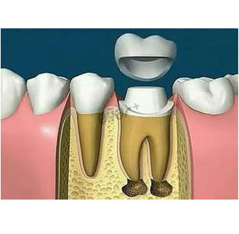 4,根管治疗结束后要观察1-2周,没有异常,需要给这个牙做一个牙套保护