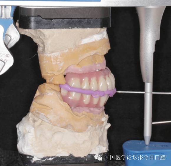 全口即刻种植即刻负重种植整体桥一例——陈钢主任医师