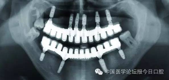 全口即刻种植即刻负重种植整体桥一例——陈钢主任医师