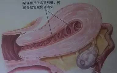 流产后宫腔粘连怎么办