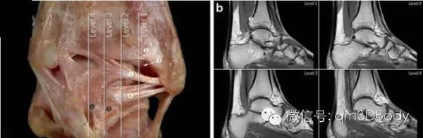 看图学习?踝关节韧带解剖