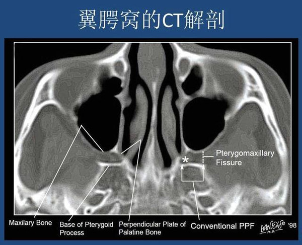 翼腭窝的结构