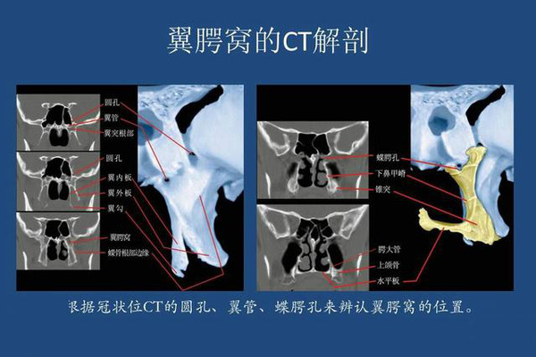 翼腭窝的结构