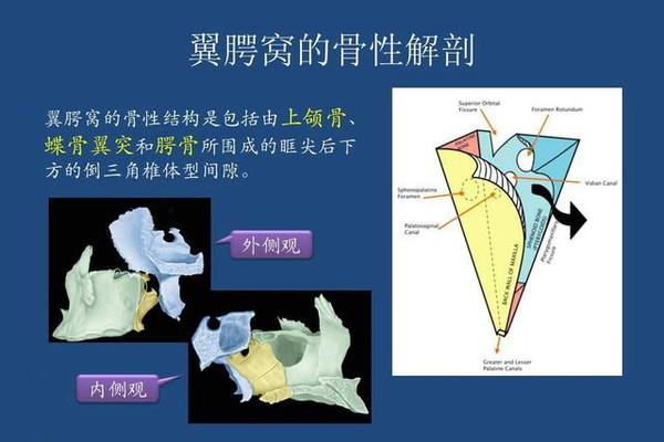 翼腭窝是一狭窄裂隙, 由蝶骨体,蝶骨翼突和腭骨垂直板,上颌窦后壁围成