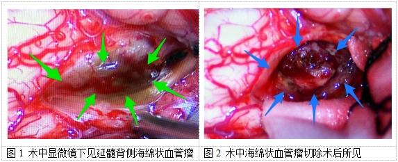 延髓海绵状血管瘤能治好吗?