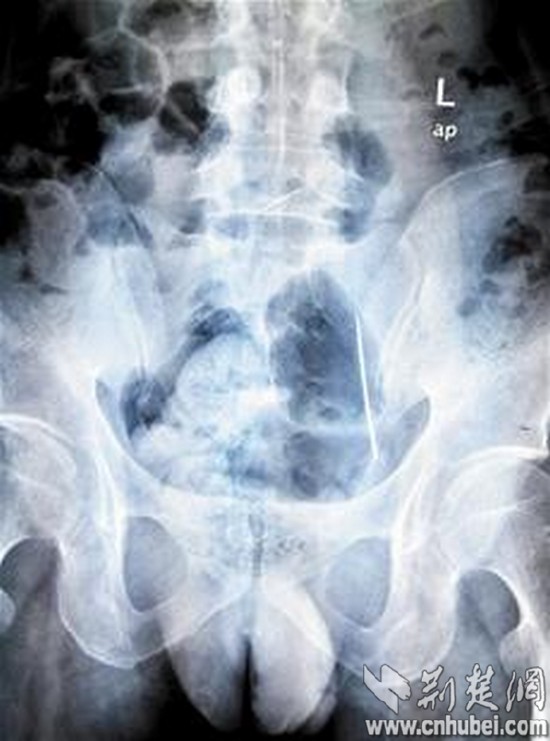 颈痛男CT查病因 两根缝衣针在腹部游走两年(图)