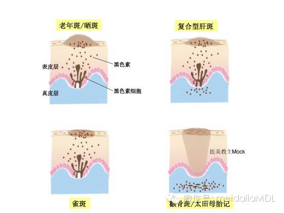 爱美姿势 颧骨斑:位于真皮层,通常在两侧脸颊颧骨上,是因为真皮层