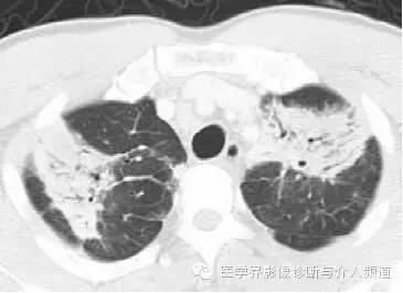 慢性嗜酸粒细胞性肺炎,这样