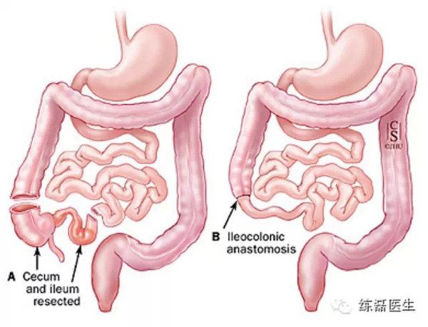 克罗恩病术后复发的治疗