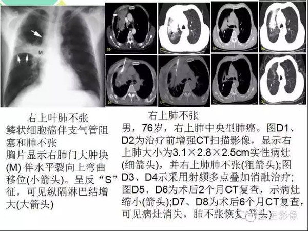 肺不张 肺实变,这些影像特征你当知!