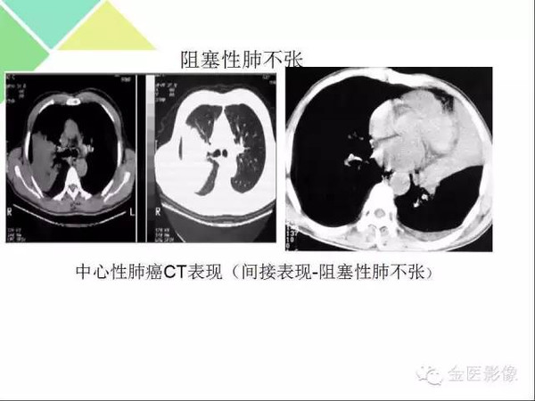 肺不张肺实变这些影像特征你当知