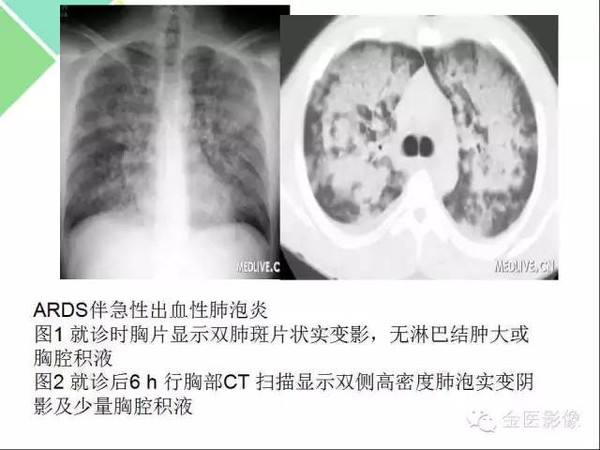 肺不张肺实变这些影像特征你当知