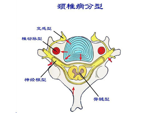 颈椎病系列:椎动脉型颈椎病的症状以及饮食的宜忌