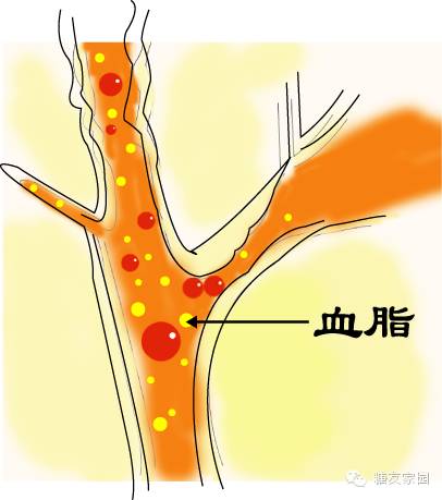 血脂是血液中胆固醇,甘油三酯,脂肪和磷脂的总称,易导致心血管疾病的