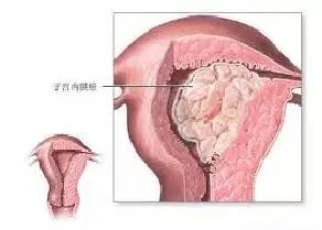 经阴道彩色多普勒诊断子宫内膜息肉的价值1