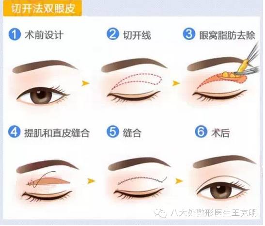 双眼皮手术后可能出现的问题都有哪些