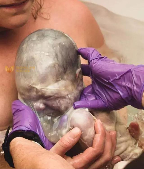 羊水未破,胎儿出生时被羊膜囊包裹的样子