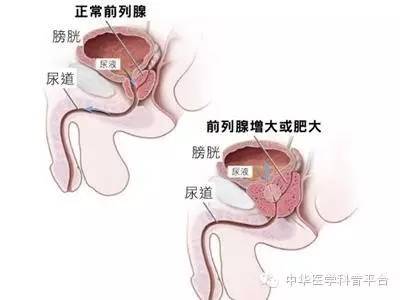 良性前列腺增生是老年人专利吗