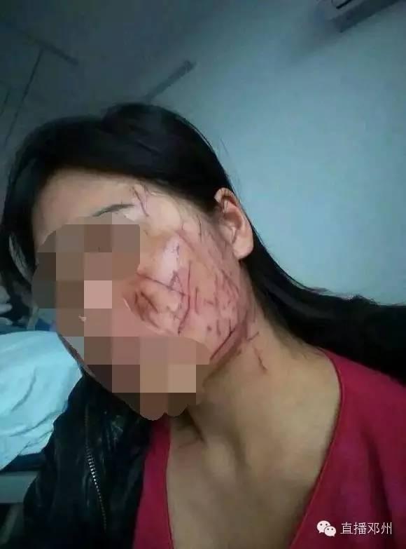 日前,一组《邓州一女子被老公和小三打成重伤脸部被划近百刀》的照片在网上和微信上疯传。照片显示,一女子脸部被锐器划伤,惨不忍睹;并晒出丈夫与小三私密照片。记者调查采访发现,这是一起因丈夫在婚姻存续期间,与第三者同居引发的暴力事件。目前,当地警方已介入调查。照片中被划伤脸部的女子景某向记者讲述了被伤害毁容的过程。