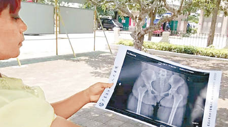事主母亲展示女儿的X光片（图片来源：香港《东方日报》网站）