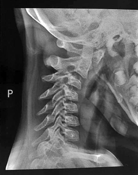 10岁女孩每天低头玩手机 颈椎折了(图),颈椎曲