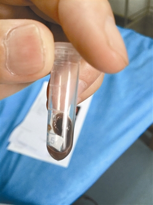 医生取出水蛭后测量,竟长达10厘米。