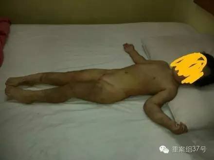 被生父殴伤女孩遍体鳞伤。 收集图像